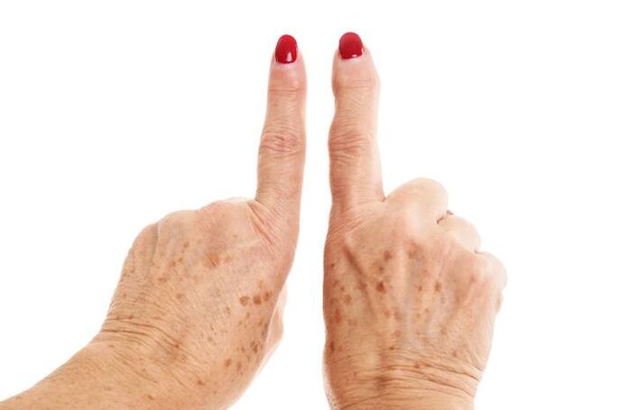 artroză deformantă pe degete