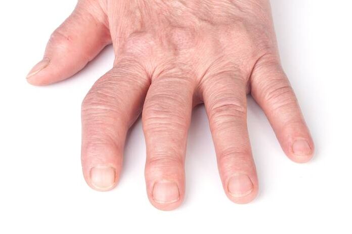 artroză deformantă pe mâini
