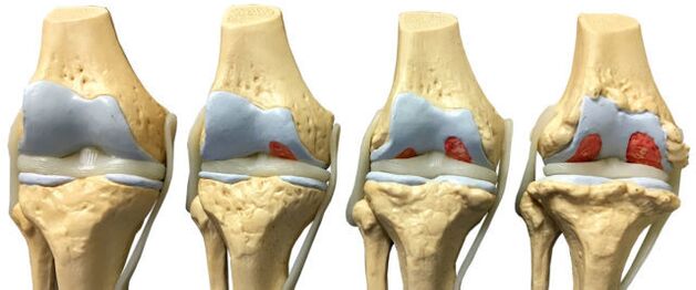 afectarea articulațiilor în diferite stadii de dezvoltare a artrozei gleznei