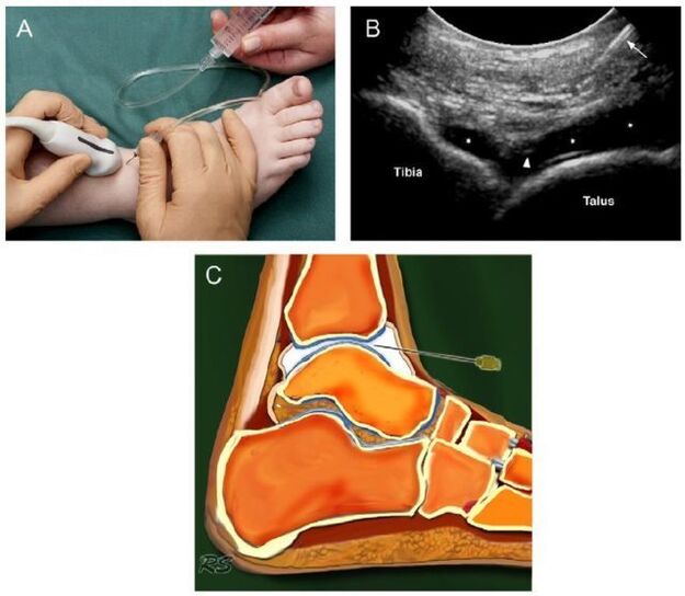 ecografia articulației gleznei cu artroză