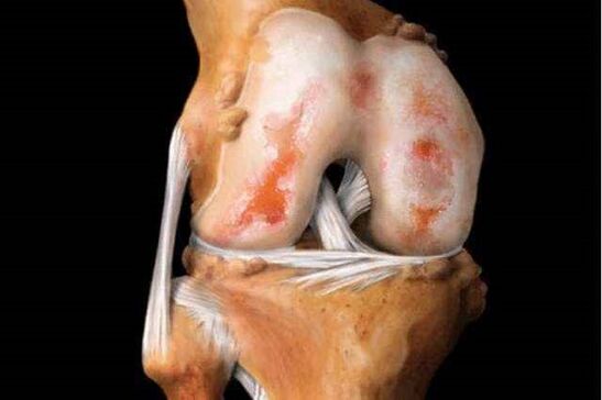 afectarea articulației genunchiului cu artroză