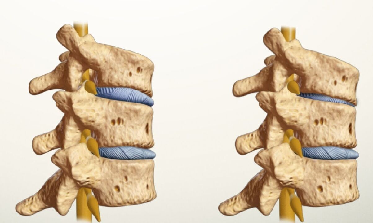 coloana vertebrală sănătoasă și bolnavă cu osteocondroză lombară