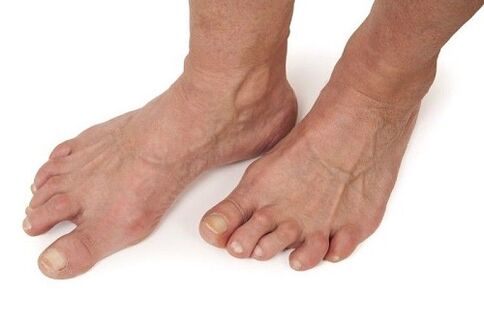 picioarele afectate de artroză