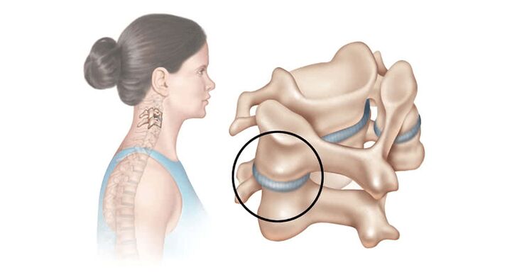 Osteocondroza toracică - simptome și semne, manifestări, natura durerii și tratament - Flekosteel