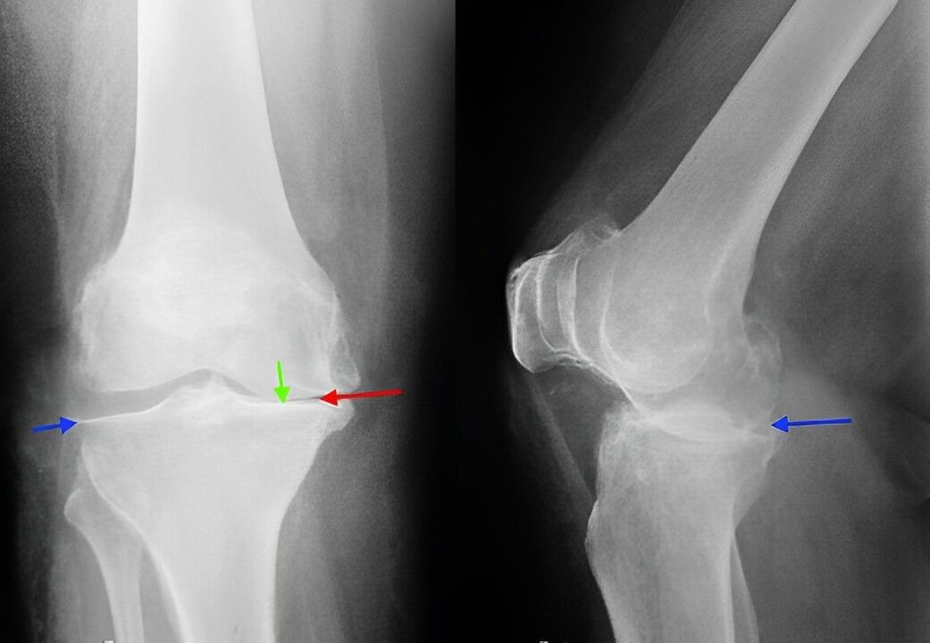 radiografie a artrozei articulației genunchiului