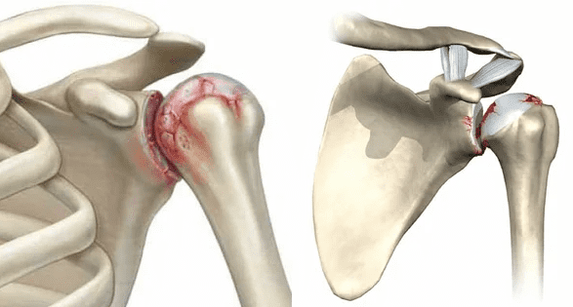 cum arată artroza articulației umărului