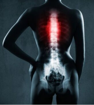 Zona afectată a coloanei vertebrale cu osteocondroză toracică