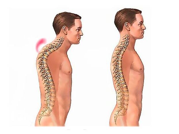 Cifoza coloanei vertebrale