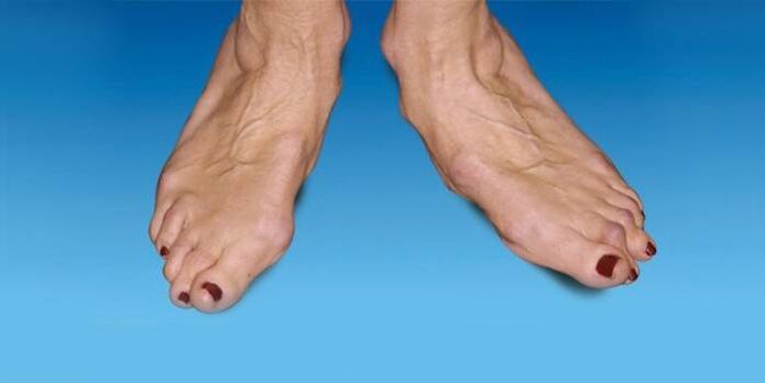 deformarea piciorului cu artroza gleznei