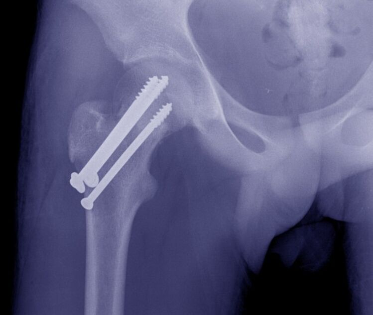 Radiografia articulației șoldului, osteosinteza fracturii cu dispozitive de fixare internă
