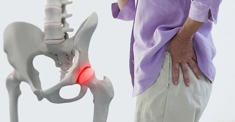 durere în zona șoldului - un simptom al artrozei articulației șoldului